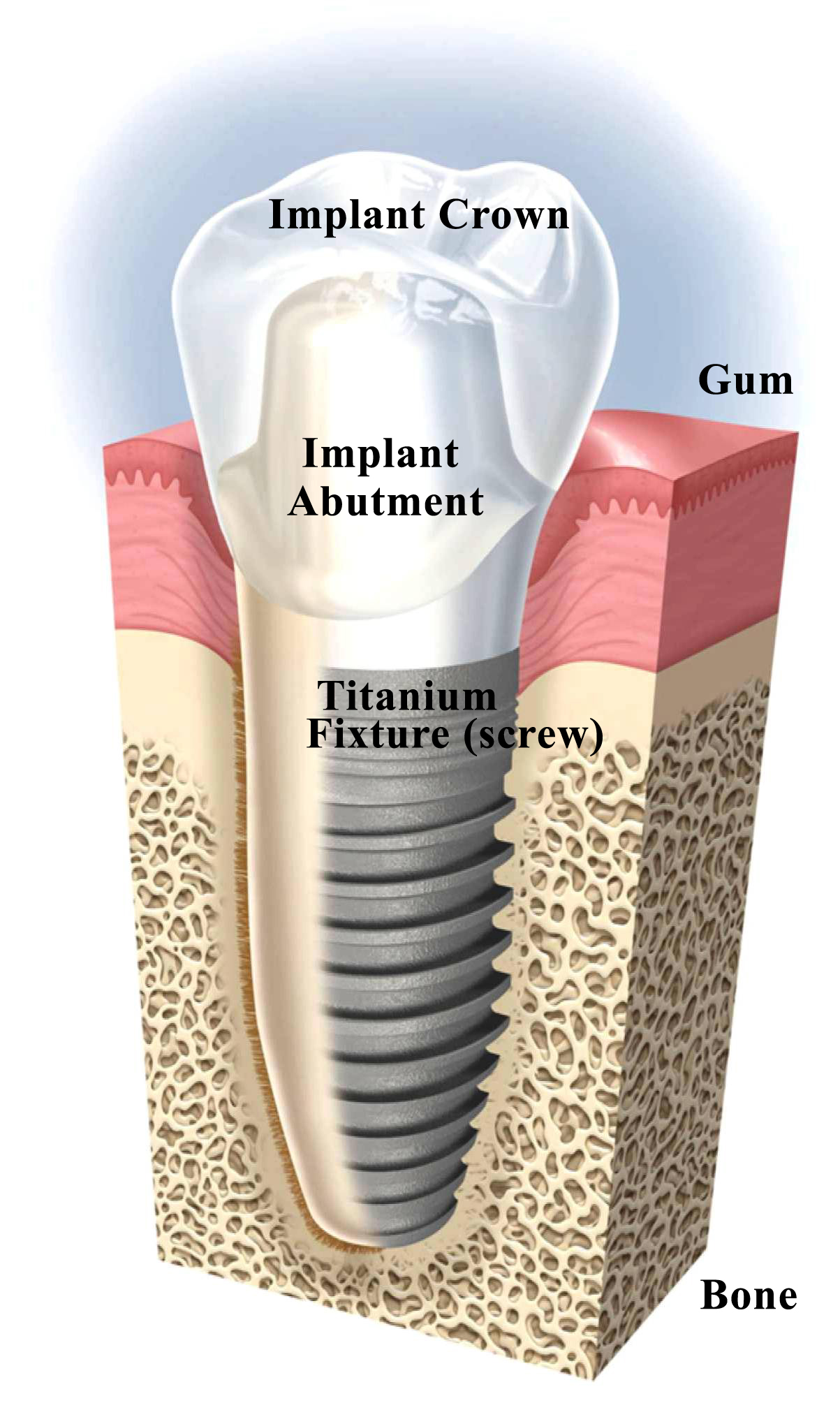 Cost of Dental Implants | Dentists Near Me
