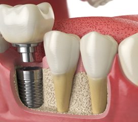 Dental implant molar